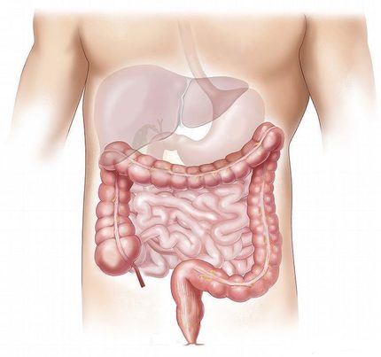 Un estudio piloto confirma que los microplásticos ya han llegado al intestino humano